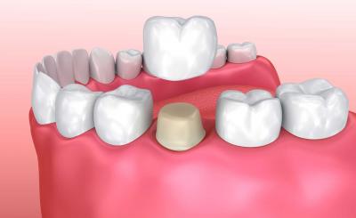 implant dentaire lyon